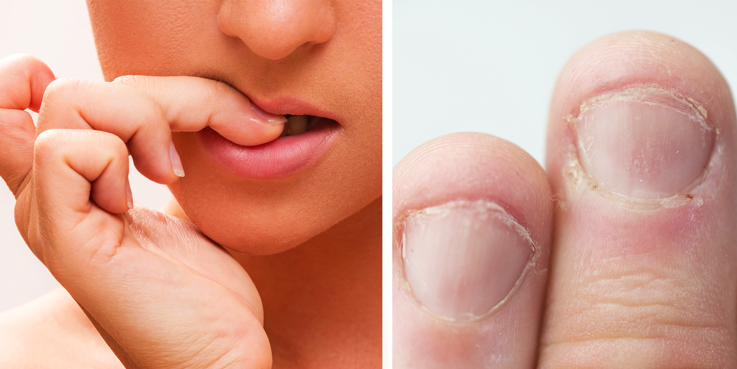 New Study Finds That All People Who Bite Their Nails Have This One 