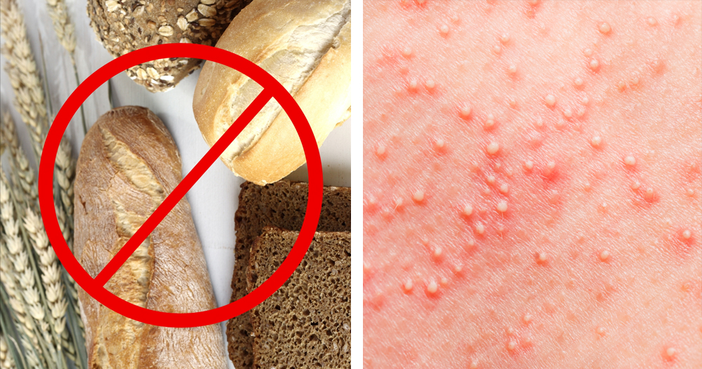 9-signs-and-symptoms-that-you-have-a-gluten-allergy-and-don-t-even-know