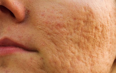 6 Natural and Effective Ways To Get Rid of Acne Scars Quickly.