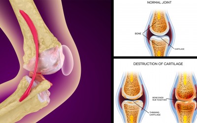 How You Can Strengthen Damaged Knee Joints and Heal The Pain In Your Knees Naturally, Without Surgery or Pills