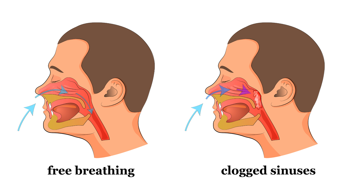 Do You Have A Stuffed Nose Or Clogged Sinuses This Simple Trick Will 