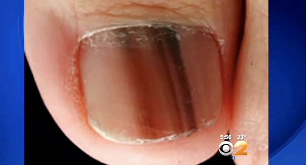 If You Notice A Black Line On Your Nail Or Someone Else s It Means THIS