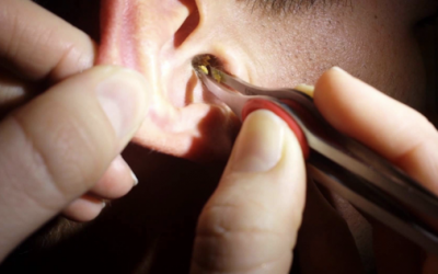 For Years He Couldn’t Hear Because Of A Monster Blockage Of Earwax. When Removed It’s Oddly Satisfying!