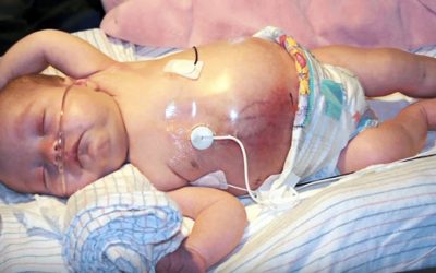 Doctors Notice Something Strange Growing In THIS Infant’s Tummy. Then Realize It’s Growing In Her Twin Too!