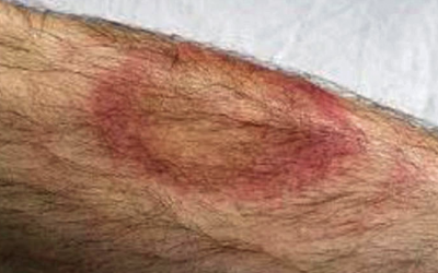 He Died Days After THIS Strange Red Spot Appeared. When The Docs Figured Out Why They Freaked!