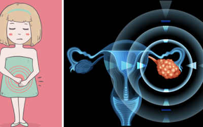 These Are The 6 Most Common Signs Of Ovarian Cancer That Are Overlooked and Missed!