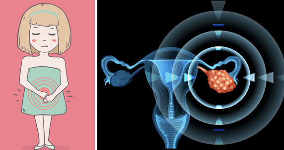 These Are The 6 Most Common Signs Of Ovarian Cancer That ...