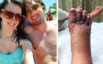 Boyfriend and Girlfriend Go For a Romantic Walk Along The Beach. 48 Hours Later They Notice Their Feet Look Strange!