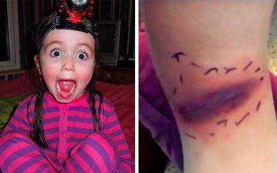 Mom Noticed a Strange Bruise on The Back of THIS 5 Year-Old’s Leg. But The Drs. Reveal The Terrifying Truth!