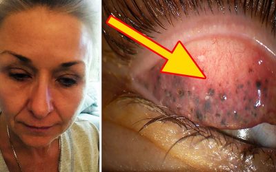 She Wore The Same Mascara To Sleep For Twenty Five Years. What The Doctors Discovered Under Her Eyelids Let Them Stunned!