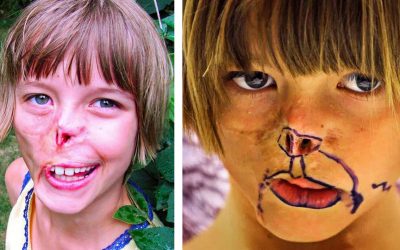 Girl’s Face Was Attacked and Devoured By A Raccoon! But After 13 Years Her 1 Dream Finally Comes True!