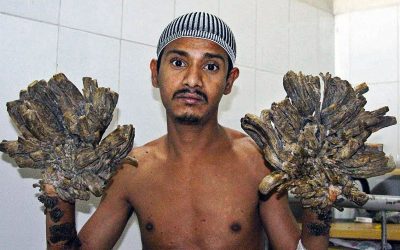 He Had a Rare Disease Called ‘Tree Man Syndrome’. The Docs Do Surgery But Come Back In and Say ‘I’m Sorry’.