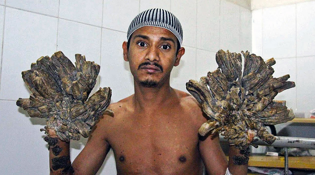 He Had A Rare Disease Called Tree Man Syndrome The Docs Do Surgery